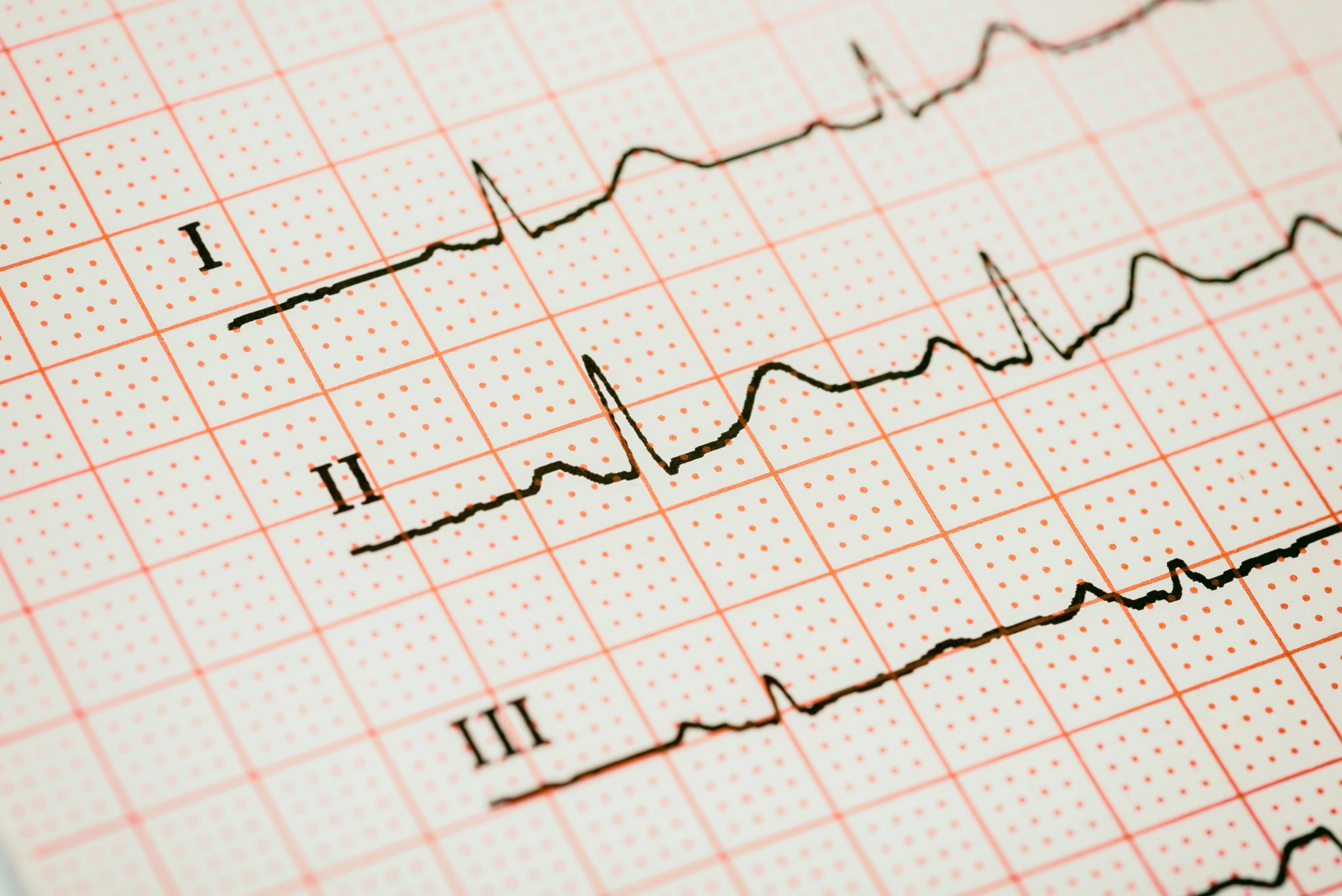 Экг сочи. Сердечный ритм кардиограмма. Ритмы сердца на ЭКГ. ЭКГ изображение. ЭКГ красивое.